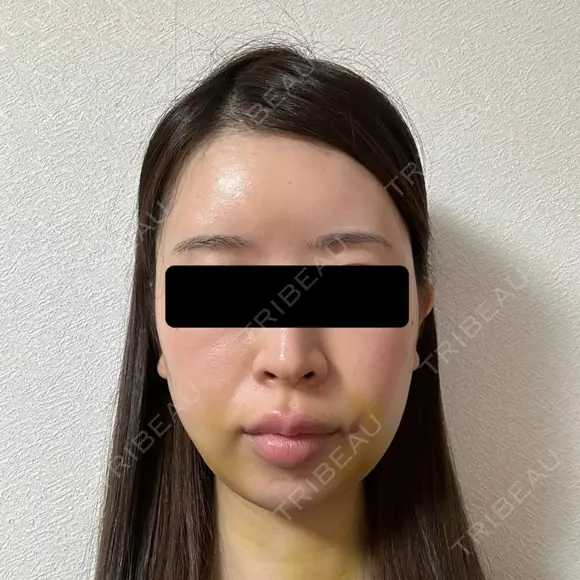 糸リフト / 脂肪吸引（顔） / ヒアルロン酸注入（あご） / ヒアルロン酸注入（こめかみ） BLINC CLINIC （ブリンク クリニック） DAY 5 メイン用