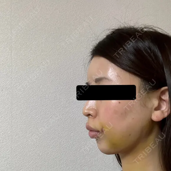 糸リフト / 脂肪吸引（顔） / ヒアルロン酸注入（あご） / ヒアルロン酸注入（こめかみ） BLINC CLINIC （ブリンク クリニック） DAY 5 メイン用