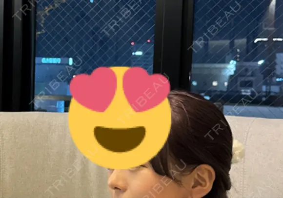 隆鼻術 / 鼻尖形成（切開） / 脂肪吸引（顔） / 軟骨移植 あいちビューティークリニック栄本院 AFTER メイン用