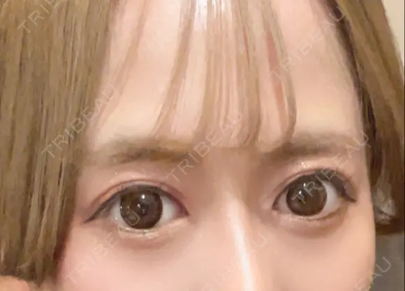 二重切開 高須クリニック 名古屋院 AFTER メイン用