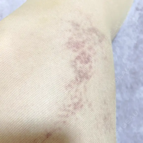 脂肪吸引（脚） / 豊胸（脂肪注入） S.T styleクリニック DAY 14 メイン用