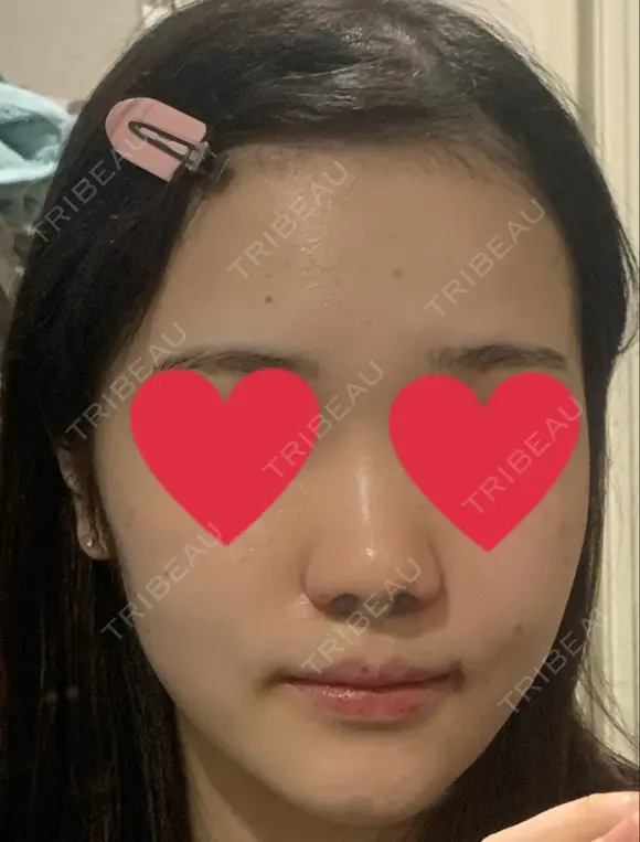 脂肪吸引注射（顔） イテウォンビューティークリニック 名古屋栄院 DAY 70 メイン用