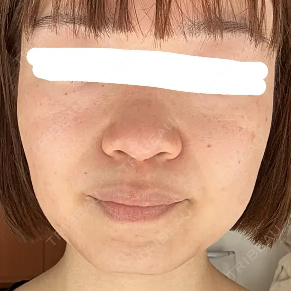 ボトックス（エラ・小顔） 湘南美容クリニック 金山院 AFTER メイン用