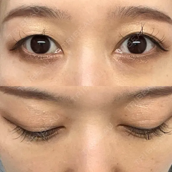 下まぶたの脂肪取り Brandnew Beauty Clinic DAY 22 メイン用