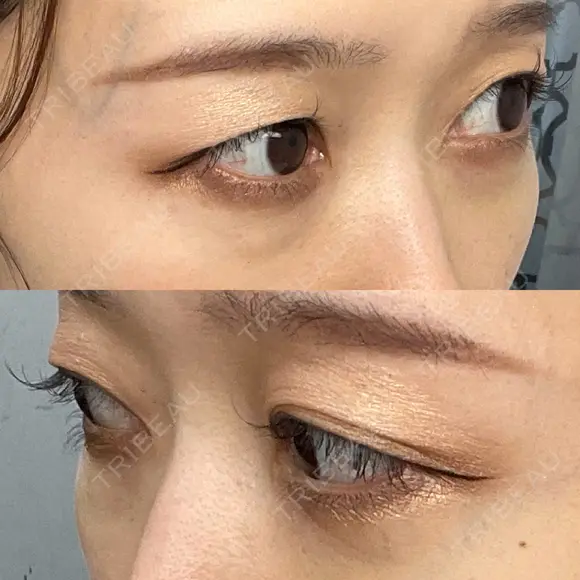 下まぶたの脂肪取り Brandnew Beauty Clinic DAY 22 メイン用
