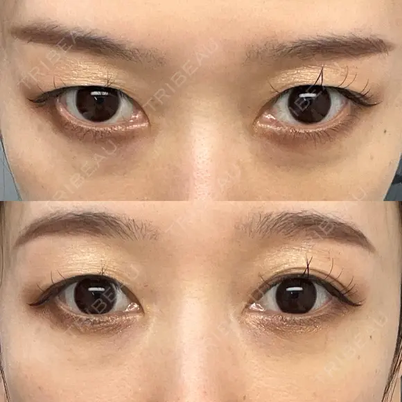 下まぶたの脂肪取り Brandnew Beauty Clinic DAY 22 メイン用