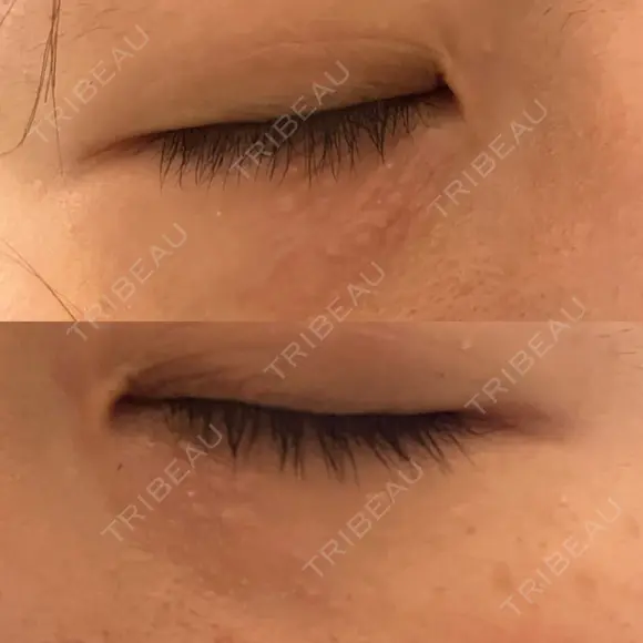 ニードルRF（ポテンツァなど） 表参道スキンクリニック 名古屋院（DAILY SKIN CLINIC提携院） DAY 7 メイン用