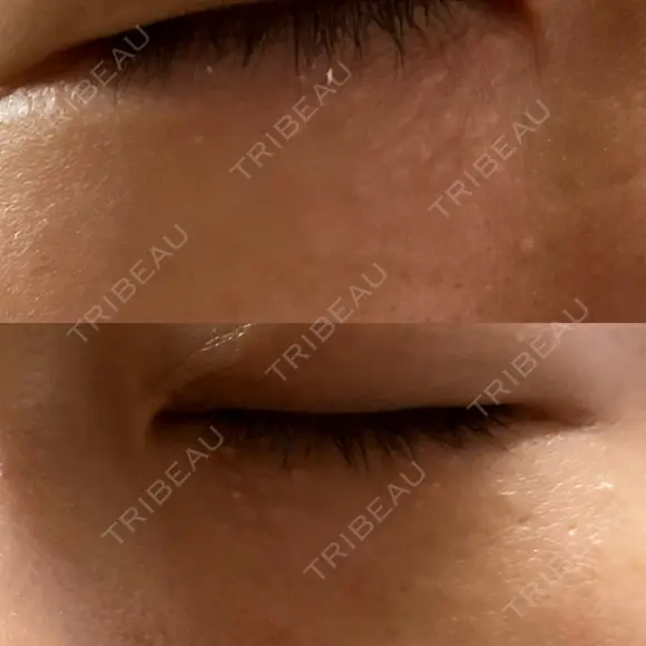 ニードルRF（ポテンツァなど） 表参道スキンクリニック 名古屋院（DAILY SKIN CLINIC提携院） DAY 8 メイン用