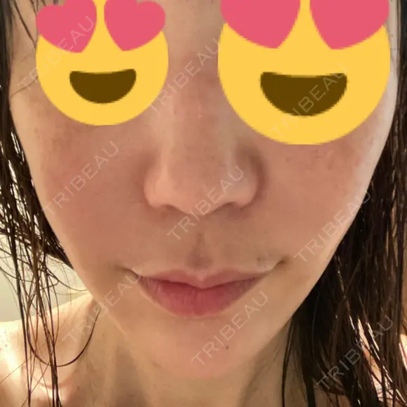 糸リフト / 脂肪吸引（顔） / ボトックス（エラ・小顔） / ヒアルロン酸注入（頬） Tokyo Tensei Clinic 新宿院 DAY 36 メイン用