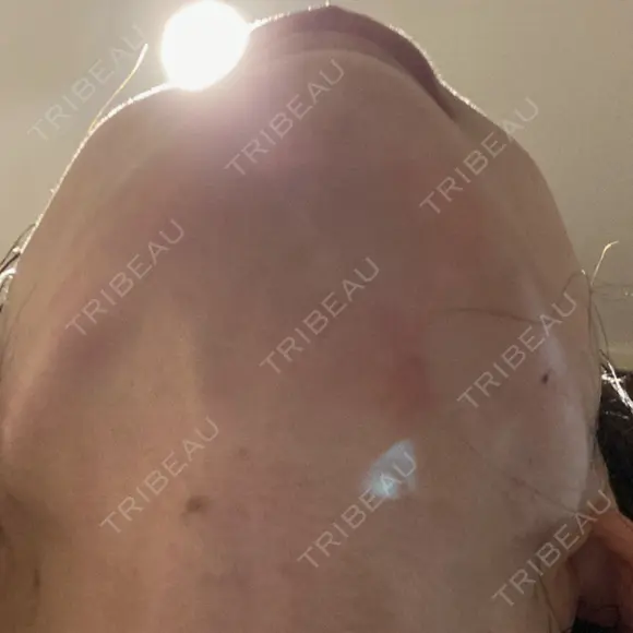 糸リフト / 脂肪吸引（顔） / ボトックス（エラ・小顔） / ヒアルロン酸注入（頬） Tokyo Tensei Clinic 新宿院 DAY 36 メイン用