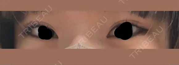 ヒアルロン酸注入（涙袋） 共立美容外科 梅田院 AFTER メイン用