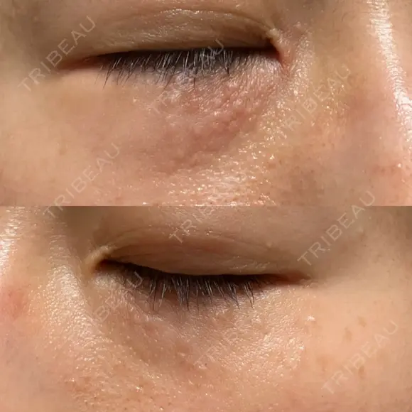 ニードルRF（ポテンツァなど） 表参道スキンクリニック 名古屋院（DAILY SKIN CLINIC提携院） DAY 9 メイン用