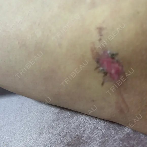 脂肪吸引（脚） / 豊胸（脂肪注入） S.T styleクリニック DAY 18 メイン用