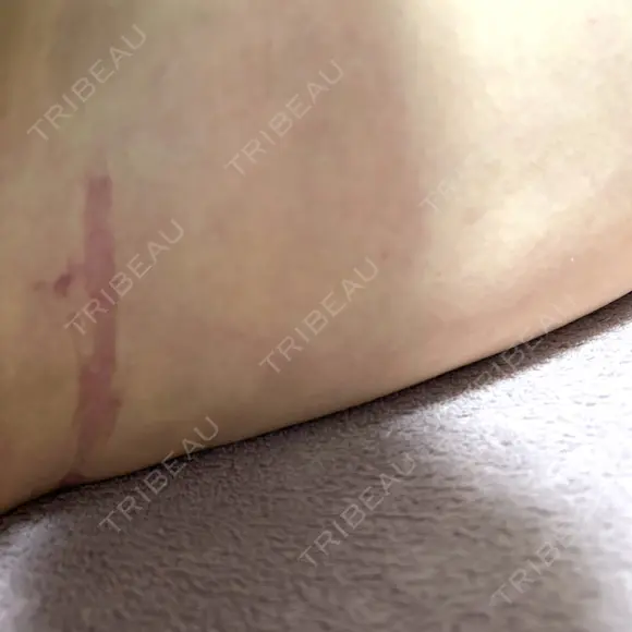 脂肪吸引（脚） / 豊胸（脂肪注入） S.T styleクリニック DAY 18 メイン用