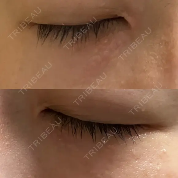 ニードルRF（ポテンツァなど） 表参道スキンクリニック 名古屋院（DAILY SKIN CLINIC提携院） AFTER メイン用