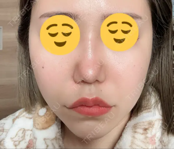 ボトックス（エラ・小顔） / ヒアルロン酸注入（頬） 高崎TAクリニック DAY 2 メイン用