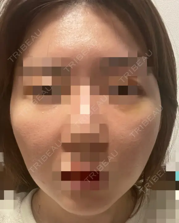 脂肪注入（額） GRACIA clinic 【グラシアクリニック】 AFTER メイン用
