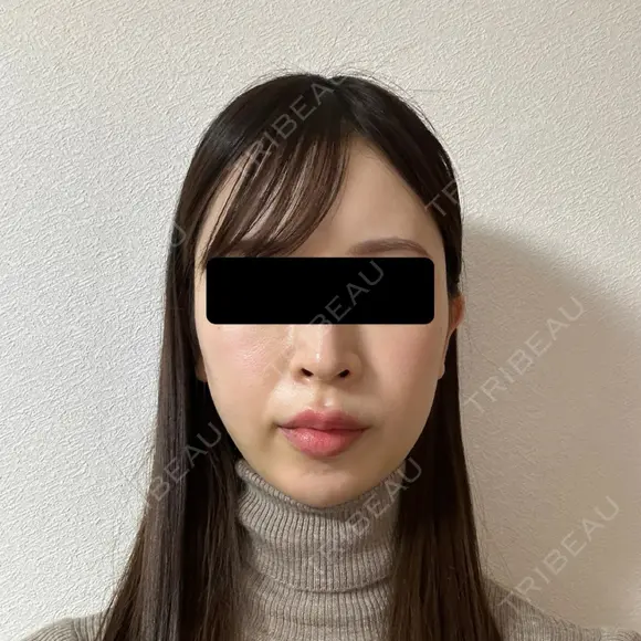 糸リフト / 脂肪吸引（顔） / ヒアルロン酸注入（あご） / ヒアルロン酸注入（こめかみ） BLINC CLINIC （ブリンク クリニック） DAY 11 メイン用