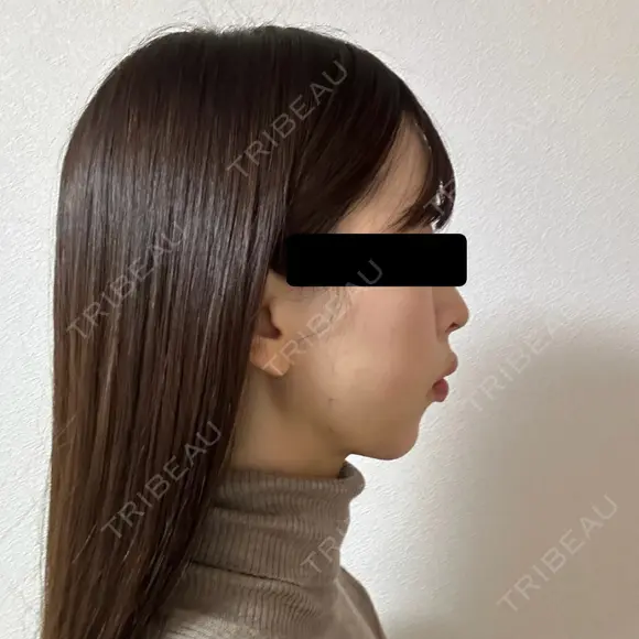 糸リフト / 脂肪吸引（顔） / ヒアルロン酸注入（あご） / ヒアルロン酸注入（こめかみ） BLINC CLINIC （ブリンク クリニック） DAY 11 メイン用