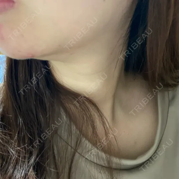 ハイフ（顔） 表参道メディカルクリニック 銀座院 DAY 0 メイン用