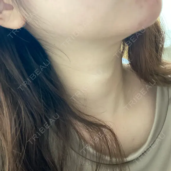 ハイフ（顔） 表参道メディカルクリニック 銀座院 DAY 0 メイン用