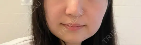 ダーマペン LIFIX BEAUTY CLINIC DAY 3 メイン用