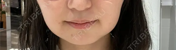 ダーマペン LIFIX BEAUTY CLINIC DAY 4 メイン用