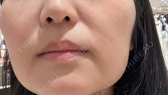 ダーマペン LIFIX BEAUTY CLINIC AFTER メイン用