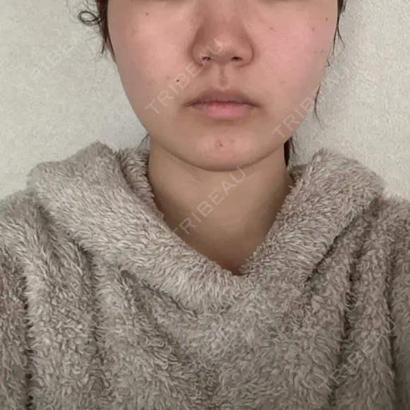 バッカルファット除去 / 脂肪吸引（顔） 湘南美容クリニック 京都院 DAY 142 メイン用