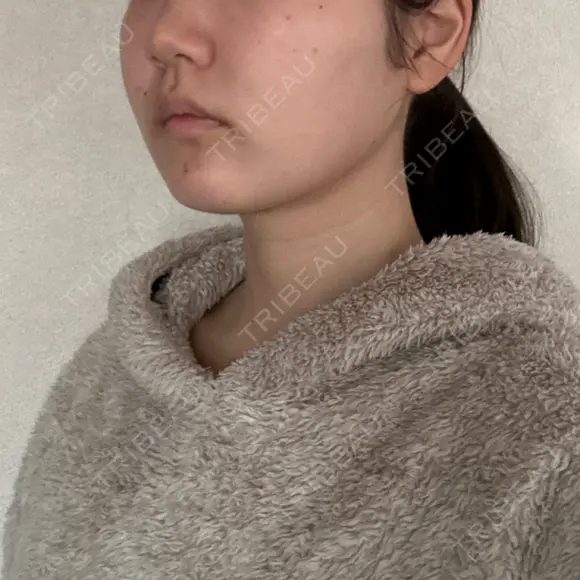 バッカルファット除去 / 脂肪吸引（顔） 湘南美容クリニック 京都院 DAY 142 メイン用