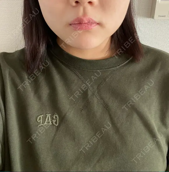 ボトックス（エラ・小顔） TCB東京中央美容外科 京都駅前院 DAY 8 メイン用