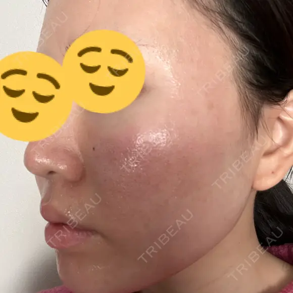 その他（肌） / 美肌レーザー 湘南美容クリニック 静岡院 DAY 0 メイン用