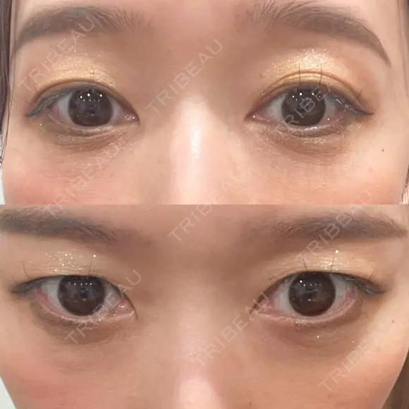 下まぶたの脂肪取り Brandnew Beauty Clinic AFTER メイン用