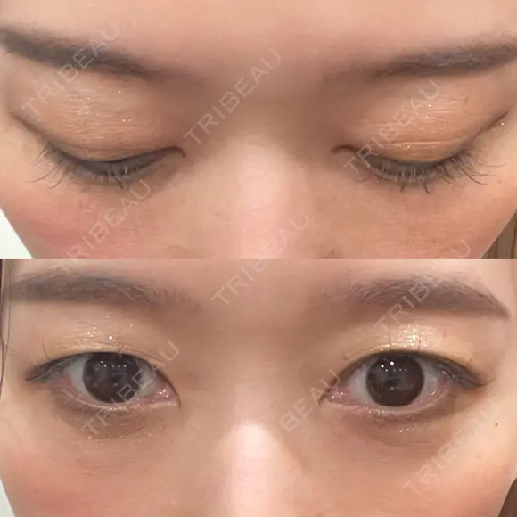 下まぶたの脂肪取り Brandnew Beauty Clinic DAY 30 メイン用