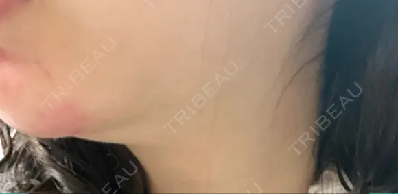 ハイフ（顔） 表参道メディカルクリニック 銀座院 DAY 2 メイン用