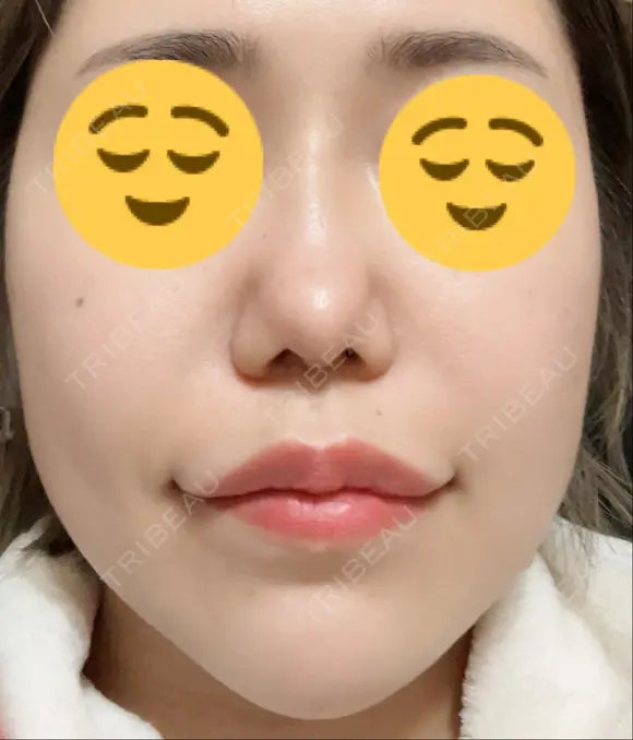 ボトックス（エラ・小顔） / ヒアルロン酸注入（頬） 高崎TAクリニック DAY 4 メイン用