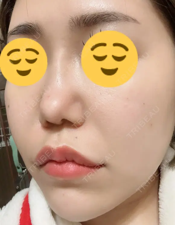 ボトックス（エラ・小顔） / ヒアルロン酸注入（頬） 高崎TAクリニック DAY 4 メイン用