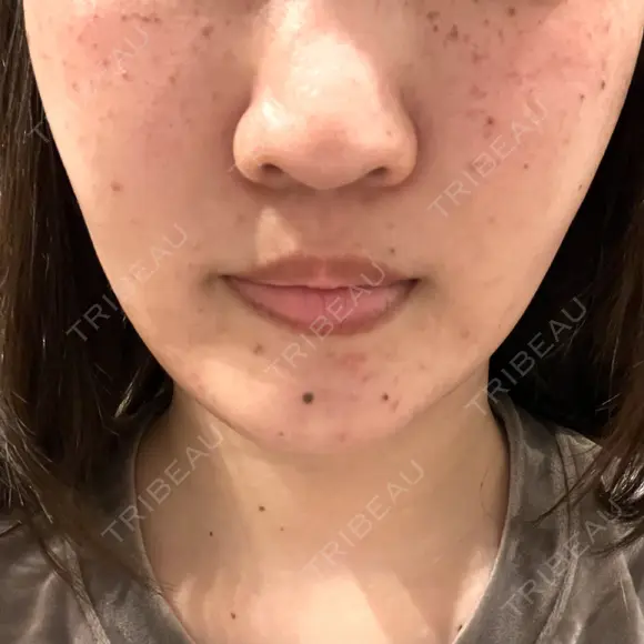 ルメッカ ルラ美容クリニック 大宮院 / ルラスキンクリニック 大宮院 DAY 0 メイン用