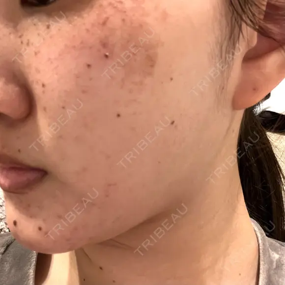 ルメッカ ルラ美容クリニック 大宮院 / ルラスキンクリニック 大宮院 DAY 0 メイン用