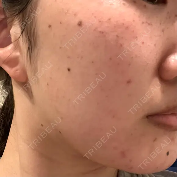 ルメッカ ルラ美容クリニック 大宮院 / ルラスキンクリニック 大宮院 DAY 0 メイン用