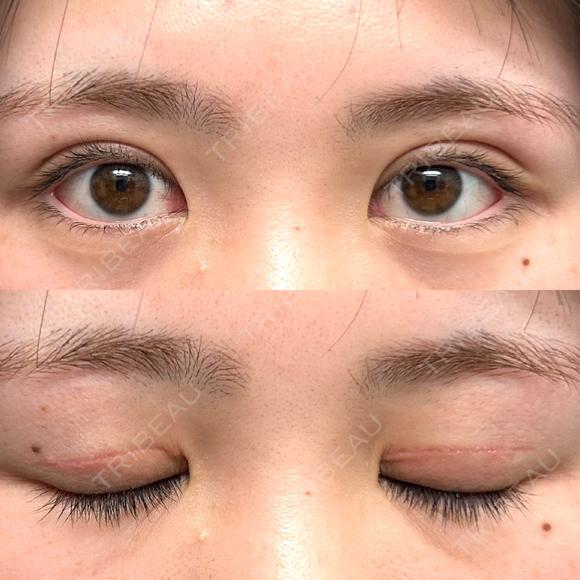 二重切開 つだ美容外科クリニック DAY 101 メイン用