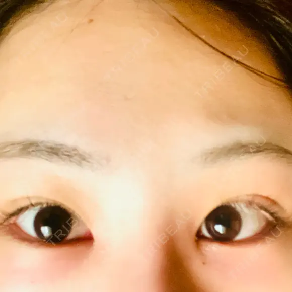 クマ治療 / ボトックス（エラ・小顔） / ヒアルロン酸注入（頬） TCB東京中央美容外科 京都駅前院 AFTER メイン用