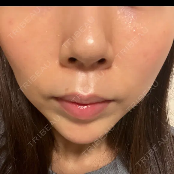 肌ヒアルロン酸注入（たるみ・シワ改善） BAO CLINIC 心斎橋院 DAY 11 メイン用