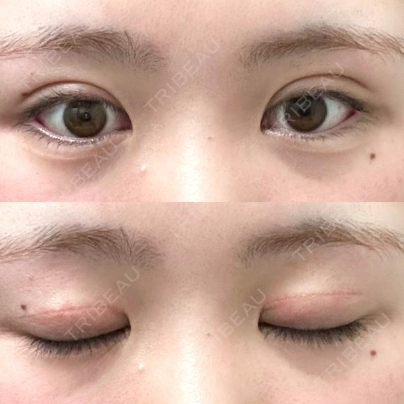 二重切開 つだ美容外科クリニック DAY 102 メイン用
