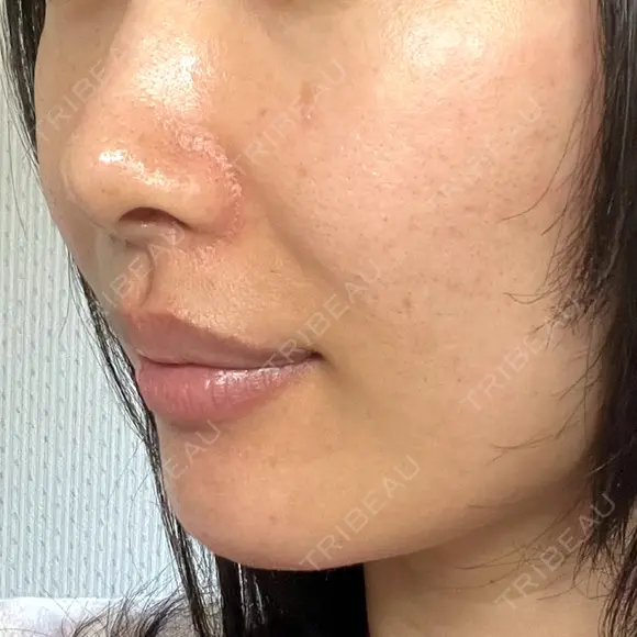 ヒアルロン酸注入（あご） / ヒアルロン酸注入（鼻翼基部） HAAB×DREAM BEAUTY CLINIC 東京本院 DAY 1 メイン用