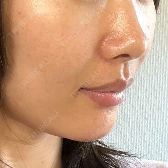 ヒアルロン酸注入（あご） / ヒアルロン酸注入（鼻翼基部） HAAB×DREAM BEAUTY CLINIC 東京本院 DAY 1 メイン用