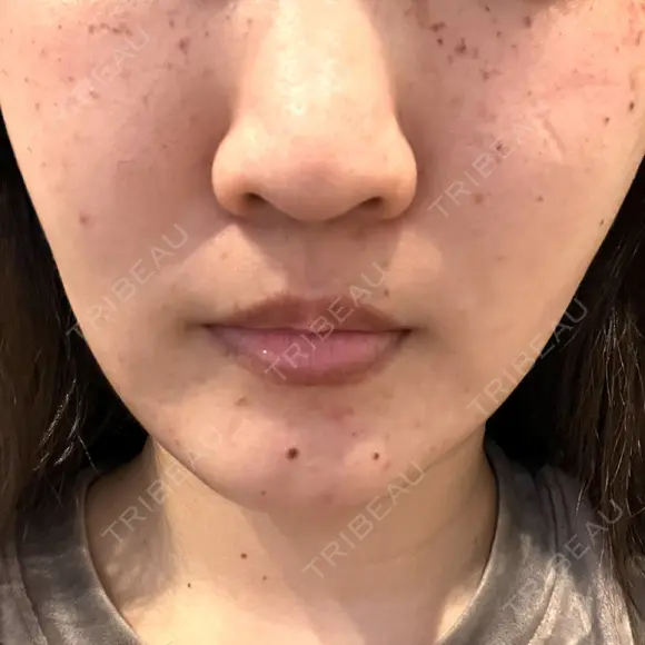 ルメッカ ルラ美容クリニック 大宮院 / ルラスキンクリニック 大宮院 DAY 1 メイン用