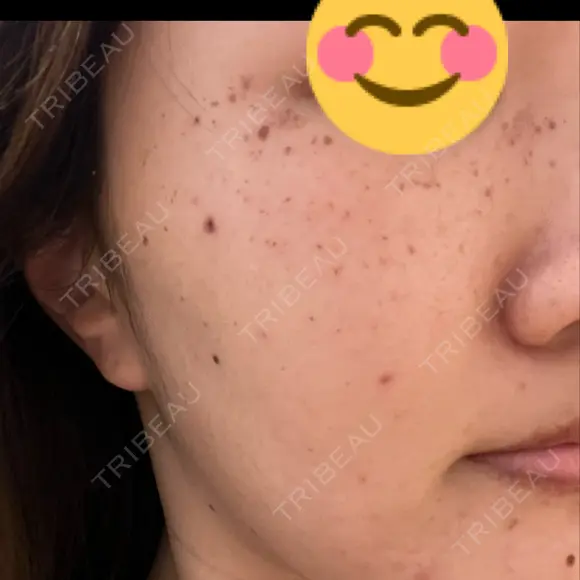 ルメッカ ルラ美容クリニック 大宮院 / ルラスキンクリニック 大宮院 DAY 1 メイン用