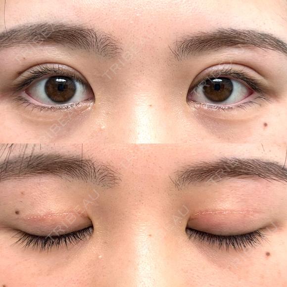 二重切開 つだ美容外科クリニック DAY 103 メイン用