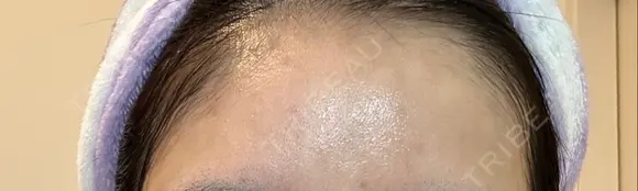 ボトックス（額） TCB東京中央美容外科 岡山院 DAY 8 メイン用